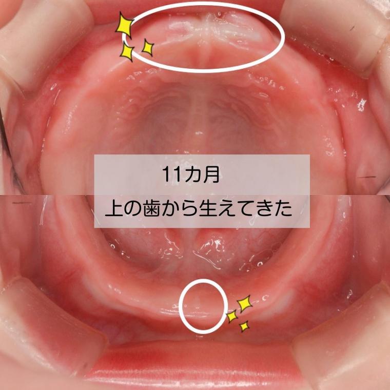 赤ちゃんの歯はいつ生える?