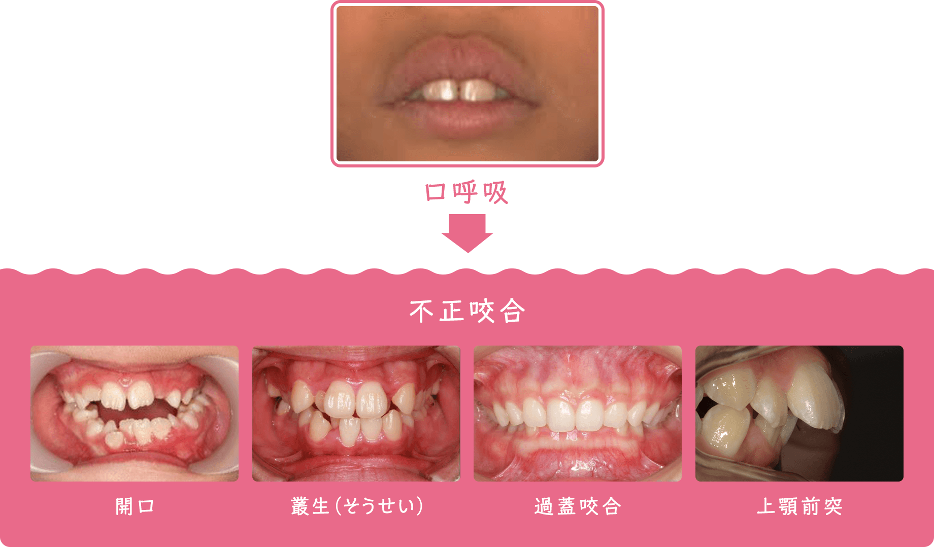 口呼吸はどんなことに影響するの…？